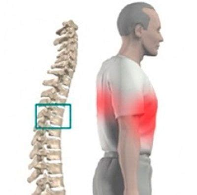 Способы лечения грудного радикулита