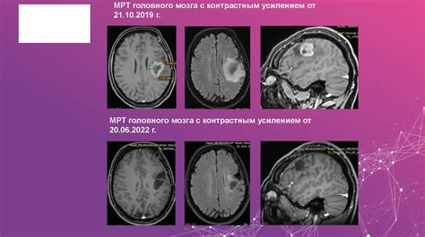 Способы лечения резидуального очага головного мозга: современные подходы