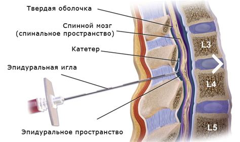 Способы прокола блокады