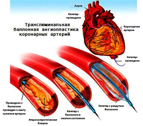 Сравнение различных типов стимуляторов сердца