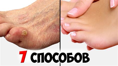 Средства от водянки на пальце: как выбрать?