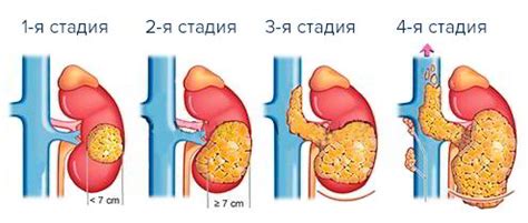 Стадии развития опухоли