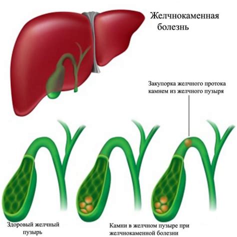Стеноз Желчного пузыря: диагностика и лечение