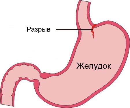 Стошнило кровью из-за рвоты