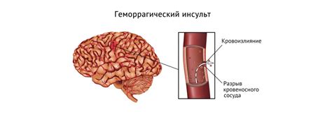 Странная редкость: патологическая разрушительная геморрагия