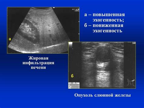 Структура и эхогенность