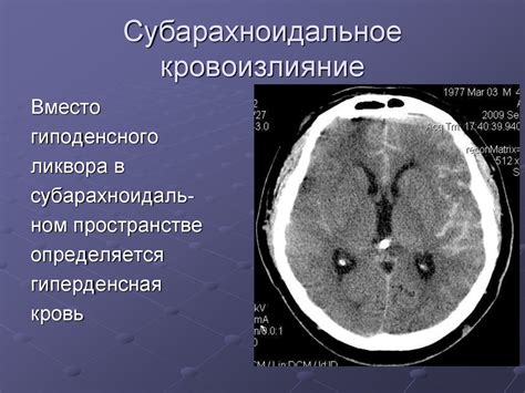 Субарахноидальное кровоизлияние