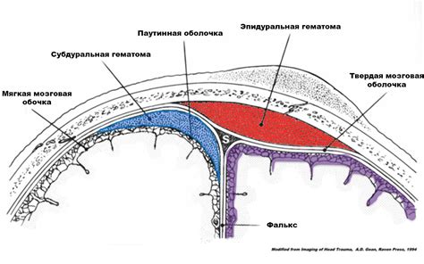 Субдуральное кровоизлияние