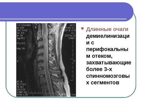 Субкортикальные очаги и их значение в организме