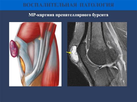 Супрапателлярный бурсит коленного сустава