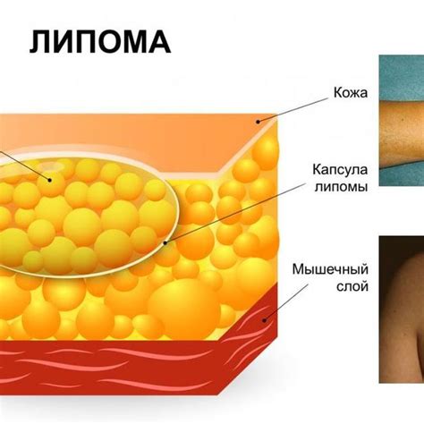 Существующие методы избавления от шариков под кожей: перечень и описание