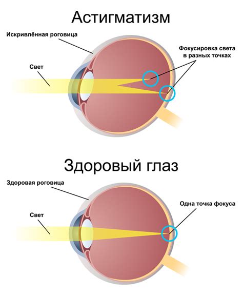 Существующие методы лечения астигматизма н52 2