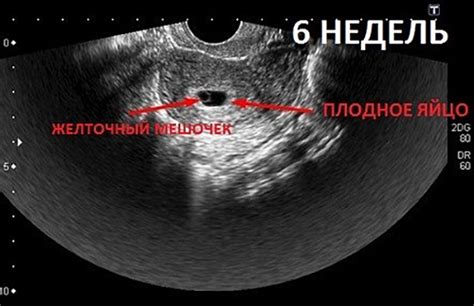 С какого дня можно увидеть плодное яйцо на УЗИ?