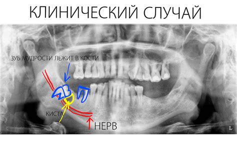 Тема 1: В чем заключается символика выпавшего тленного зуба без причинения боли и потери крови?
