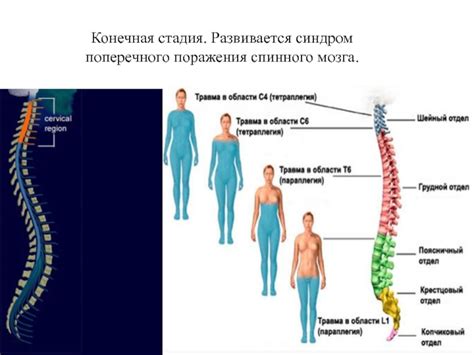 Тетраплегия: определим ее сущность