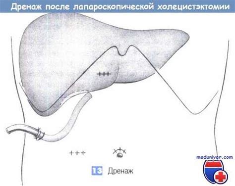 Техника проведения лапароскопической холецистэктомии