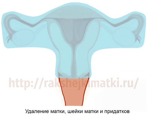 Техники удаления матки и придатков