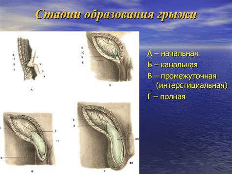 Типы грыж и их локализация