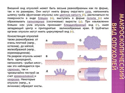 Типы кишечных опухолей