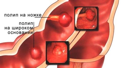 Типы полипов прямой кишки