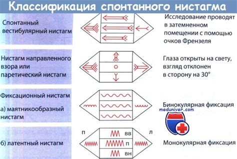 Типы спонтанного нистагма и их характеристики