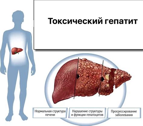 Токсический гепатит: важность и разновидности