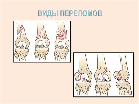 Травматические повреждения суставов рук