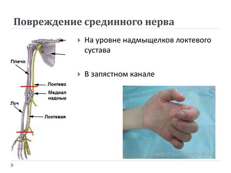 Травма или поражение нерва