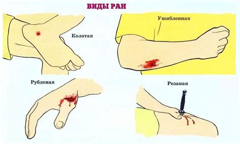 Травма или рана