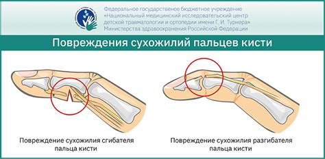 Травмы и повреждения кисти