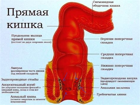 Трещины и язвы в прямой кишке: дискомфорт и болезненность