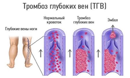 Тромбоз: как образуется сгусток крови