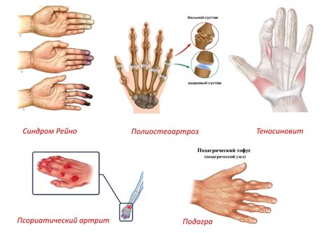 Тряска рук: симптомы, причины, диагностика и лечение