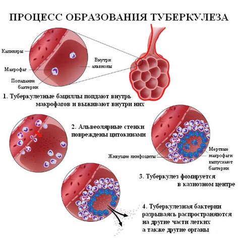 Туберкулез и другие гранулематозные заболевания