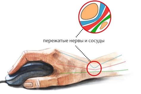 Туннельный синдром запястья: симптомы, лечение и профилактика