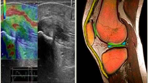 УЗИ коленного сустава: узнайте все об исследовании