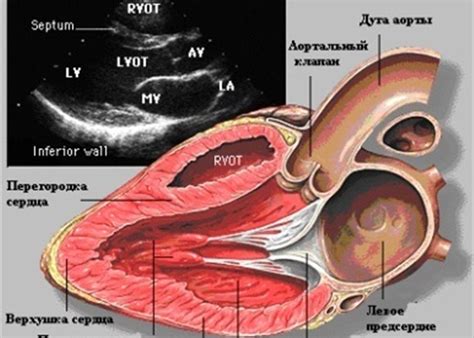 УЗИ сердца: что такое МЖП эхо