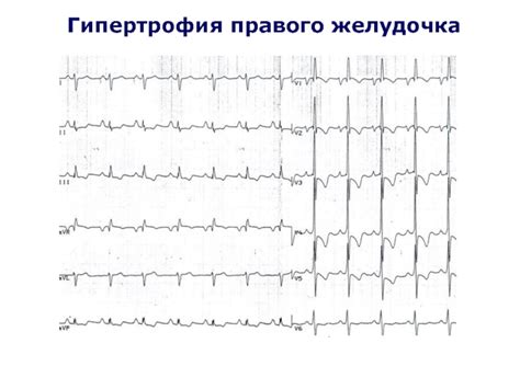 Увеличение камер сердца у женщин