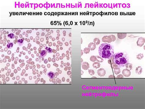 Увеличение количества лейкоцитов в копрограмме