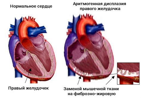 Увеличение правого желудочка сердца