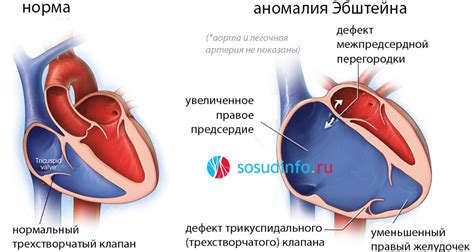 Увеличение сердца: причины и борьба