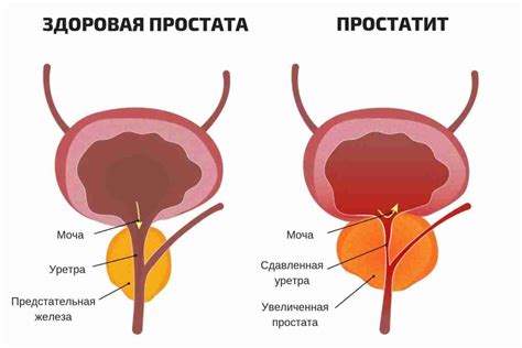 Увеличенная простата: причины, симптомы и лечение