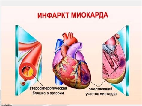 Угроза затяжного инфаркта миокарда