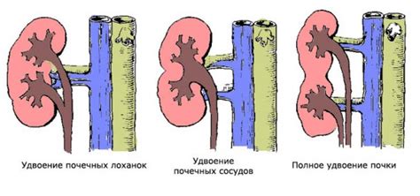 Удвоение правой почки