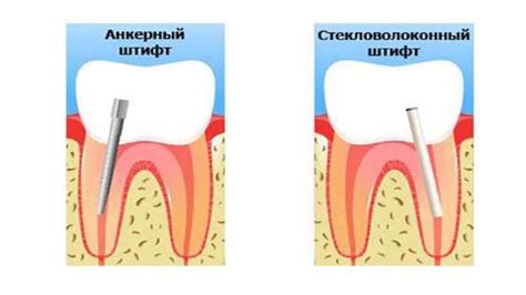 Укрепление зуба