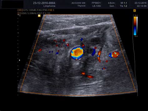Ультразвуковая диагностика щитовидной железы
