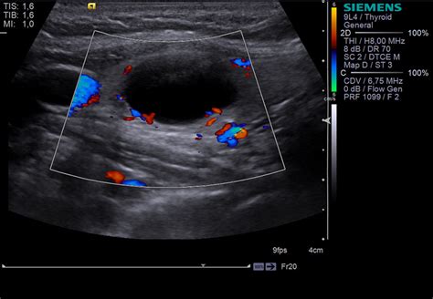 Ультразвуковое исследование щитовидной железы