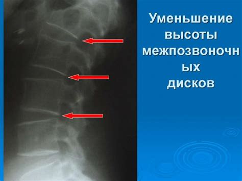 Уменьшение высоты межпозвоночных дисков может быть вызвано: