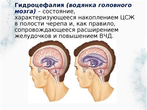 Умеренная наружная гидроцефалия головного мозга у взрослых