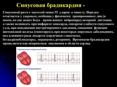 Умеренная синусовая брадикардия сердца